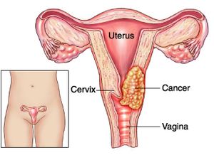 Understanding Cervical Cancer: Symptoms, Prevention and Treatment